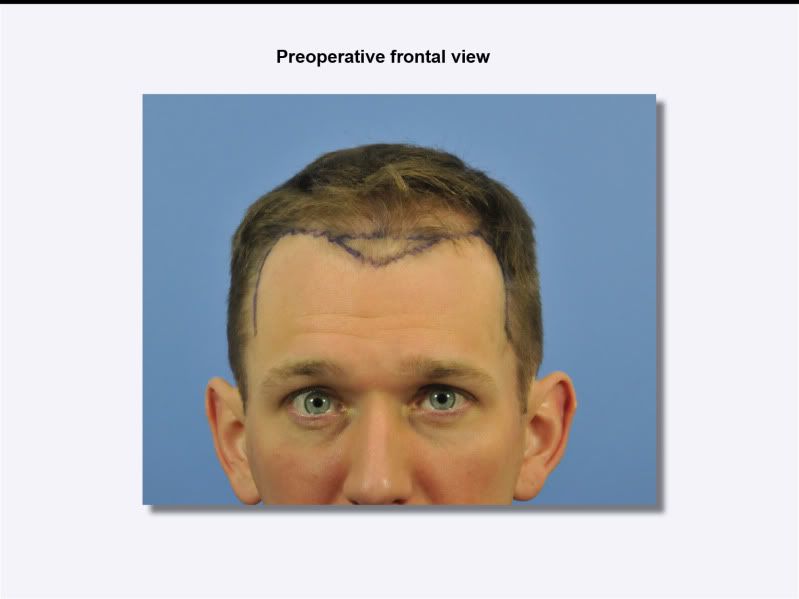 preopfrontal.jpg